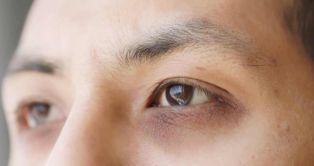 Best Under Eye Creams for Dark Circles